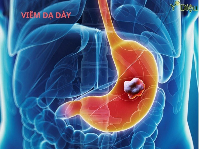 Viêm Dạ Dày Cấp Tính: Nguyên Nhân Triệu Chứng, Cách Điều Trị